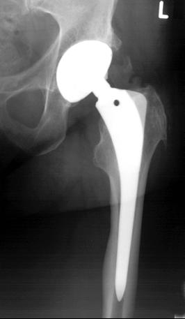 Röntgenkontrolle einer konventionellen Geradschaftprothese. Der Prothesenschaft ist tief im Markraum des Oberschenkels zentriert. Die Gelenkpfanne ist im Beckenknochen verankert. © Gelenk-Klinik Röntgenkontrolle einer Hüftprothese