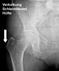 Sichtbar ist eine schmerzhafte Verkalkung der Schleimbeutel am Hüftgelenk. © Gelenk-Klinik Verkalkung der Schleimbeutel an der Hüfte