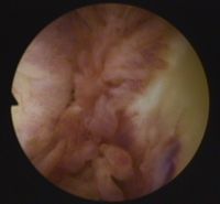 Arthroskopische Sicht auf einen entzündeten Schleimbeutel im Hüftgelenk. © Gelenk-Klinik Schleimbeutelentzündung