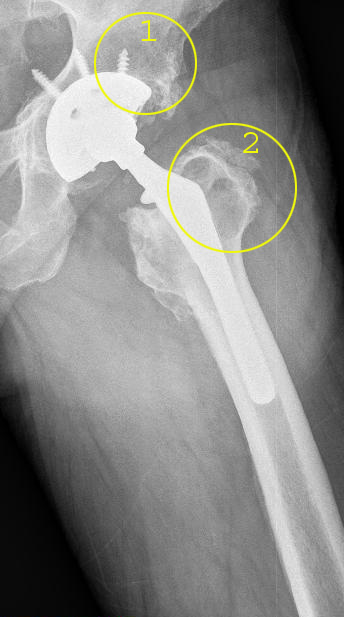 Ausgangslage: septische Osteolyse einer Hüftprothese. Gelb markiert sind die im Röntgenbild deutlich sichtbaren demineralisierten Bereiche: 1. Beckenknochen in der Umgebung der Hüftpfanne (Acetabulum): 2. Oberschenkelknochen (Femur). Diese geschwächten Bereiche sind nicht mehr in der Lage, den Prothesenschaft alleine angemessen zu halten. Die Planung des Hüftprothesenwechsels muss das berücksichtigen und die Befestigung durch Ersatzmaterialien oder andere Befestigungsstrategien ergänzen. © Dr. Martin Rinio Septische Osteolyse einer Hüftprothese