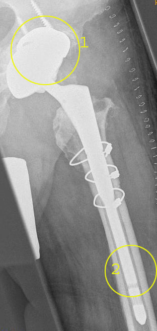 Gleicher Patient: Prothesenrevision nach septischer Osteolyse einer Hüftprothese. 1. Knochenersatz hat die demineralisierten Bereiche des Knochens im Becken gezielt verstärkt. 2. Die tiefe Verankerung der Ersatzprothese im Röhrenknochen entlastet den durch die Infektion geschwächten Oberschenkelknochen. Die kreisförmigen Drähte (Cerclage) umgeben den Femur (Oberschenkelknochen) und stabilisieren ihn, da er zur Entfernung des infizierten Prothesenschaftes der Länge nach aufgespalten und aufgeklappt wurde (transfemoraler Zugang). © Dr. Martin Rinio Septische Osteolyse einer Hüftprothese: Prothesenrevision