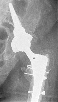 Hochbetagte Patientin nach Sturz auf die linke Hüfte: Durch die Fraktur hat sich die Gelenkpfanne (Acetabulum) gelockert. Nach einem Wechsel der Hüftprothese gleicht eine Sockelpfanne mit einem im dorsalen (rückseitigen) Beckenknochen verankerten Aufsatz die Instabilität aus. Dieser fügt sich optimal in die Form der Hüftpfanne ein. Es erfolgt eine zusätzliche Befestigung durch Knochenschrauben. © Dr. Martin Rinio Befestigung der Hüftpfanne mit Sockelpfanne