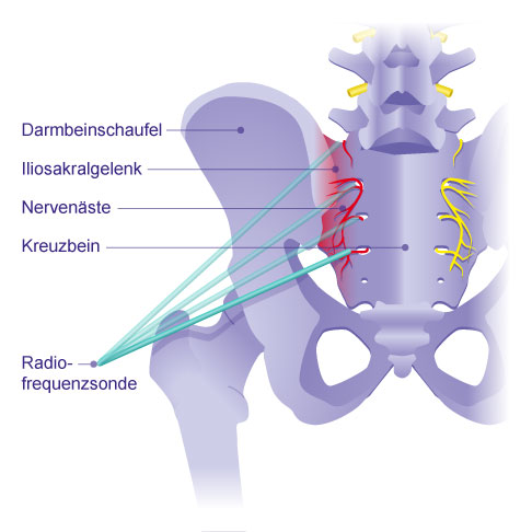 Bei der ISG-Denervierung werden mit der Radiofrequenzsonde die kleinen Nervenäste verödet, die Schmerzsignale aus dem erkrankten Iliosakralgelenk zum zentralen Nervensystem transportieren. © Gelenk-Klinik ISG-Denervierung