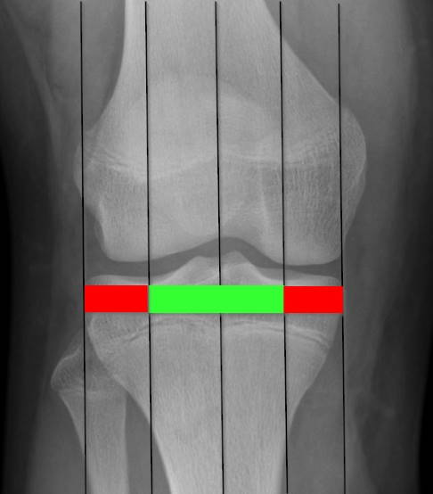 Verläuft die mechanische Beinachse durch den grünen Bereich, ist keine Korrektur erforderlich. Verläuft sie im roten Bereich, liegt eine krankhaft veränderte Beinachse vor. © Gelenk-Klinik Einschätzung der Beinachsen anhand von 4 Quadranten im Röntgenbild