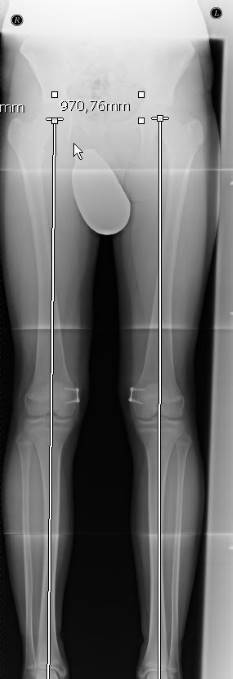 Gleicher Patient: Nach 11 Monaten ist eine Begradigung der Beinachsen eingetreten, sodass die Implantate entfernt werden können. © Gelenk-Klinik Röntgenbild: Die operative Korrektur hat zu einer Begradigung der Beinachsen geführt.