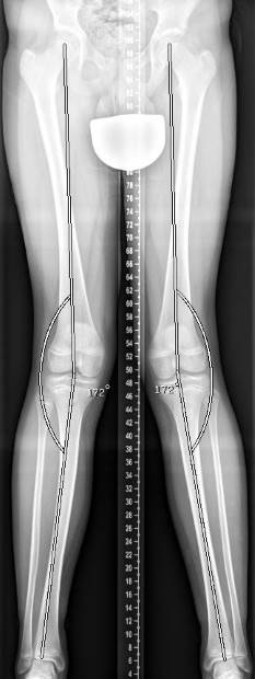 Röntgenbild eines beidseitigen Genu valgum (X-Bein) bei einem 14-jährigen Jungen. Die Abweichung der Fehlstellung von der normalen Beinachse beträgt 8°. © Gelenk-Klinik Röntgenbild einer Beinachsenfehlstellung (X-Bein) bei einem 14-jährigen Jungen