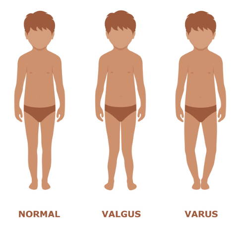Man unterscheidet grundsätzlich zwei Formen der Beinachsenfehlstellung: 1. Bei der Valgusfehlstellung (Genu valgum) weicht der Unterschenkel im Vergleich zum Oberschenkel nach außen ab. Man spricht auch vom X-Bein. 2. Die Varusfehlstellung (Genu varum) zeichnet sich durch einen im Vergleich zur Oberschenkelachse nach innen abweichenden Unterschenkel aus. Diese Fehlstellung bezeichnet man als O-Bein. © kowalska-art, iStock Beinachsenfehlstellungen: normale Beinachse, Valgusstellung, Varusstellung