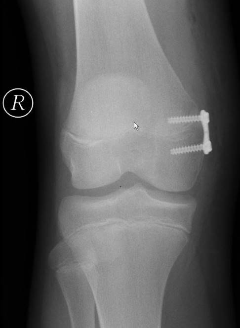 Ein spezielles Implantat blockiert die Wachstumsfuge im Femur (Oberschenkelknochen) auf der inneren Seite des Kniegelenks. Auf der anderen Seite wächst der Knochen weiter, wodurch sich die Beinachse nach einiger Zeit begradigt. © Gelenk-Klinik Röntgenbild einer operativen Korrektur einer Beinachsenfehlstellung mittels temporärer Hemiepiphysiodese