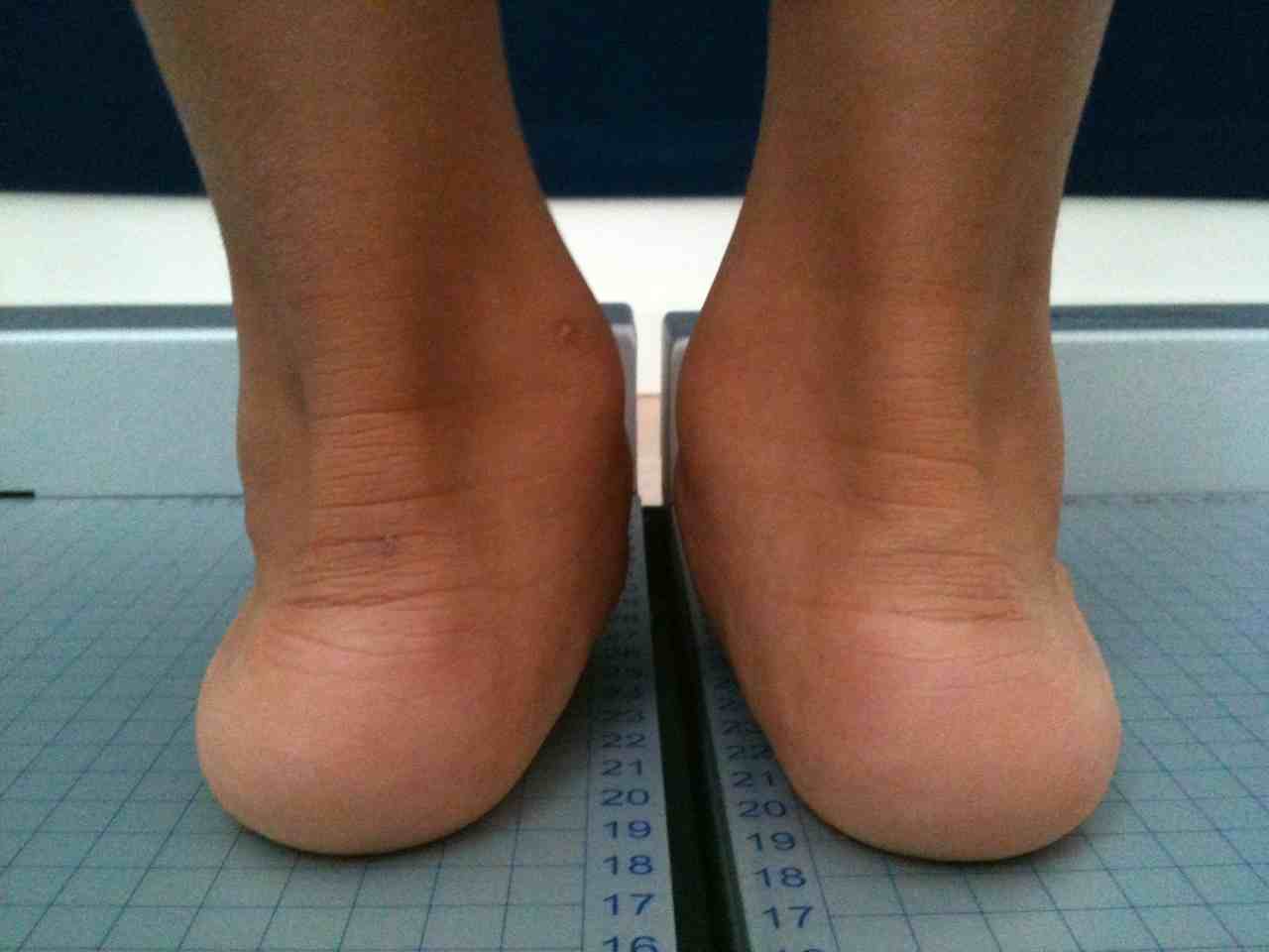 Der kindliche Knickfuß ist an der X-Stellung der Ferse und dem eingesunkenen Fußlängsgewölbe gut zu erkennen. © Gelenk-Klinik Kindlicher Knick-Fuss