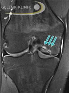 MRT: abgelöstes Dissekat im Kniegelenk