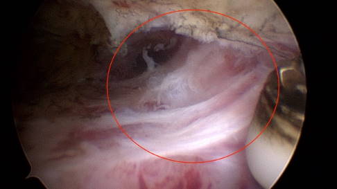 Das arthroskopische Bild zeigt die typischen Vernarbungen einer Arthrofibrose im Knie. Am oberen Rand ist die weißliche Kniescheibe zu erkennen. Sie ist umgeben von den rötlich eingefärbten arthrofibrotischen Fasern, die ihr von unten her anhaften. Diese sind rötlich, weil sie von einer Schicht entzündlicher Gelenkschleimhaut bedeckt sind. © Gelenk-Klinik Arthroskopie eines Knies mit Arthrofibrose