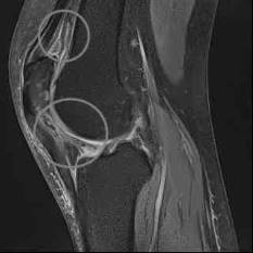 Arthrofibrose im MRT-Bild: Die Markierung zeigt die Vernarbungen. © Gelenk-Klinik MRT: Knie mit Arthrofibrose
