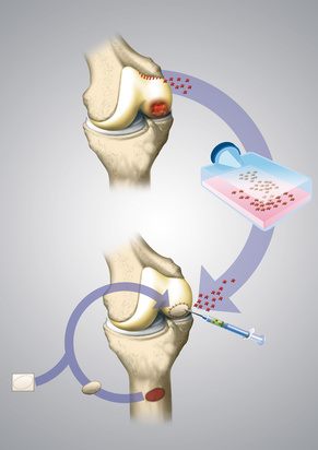 Für die Knorpelzelltransplantation werden dem Patienten in einer arthroskopischen Operation gesunde körpereigene Knorpelzellen entnommen und im Labor vermehrt. Nach der Knorpelzüchtung verpflanzt der Orthopäde die Zellen in die Defekte im Kniegelenk. © dissoid, Fotolia Knorpeltransplantation im Kniegelenk