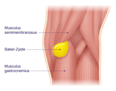 Im Bereich der Kniekehle weist die Gelenkkapsel des Kniegelenks eine Schwachstelle auf. Hier kommt es zur Bildung der Bakerzyste, die sich an der Knieinnenseite zwischen zwei Muskeln schiebt. © Gelenk-Klinik Muskulatur des Kniegelenks von hinten und Lage der Bakerzyste