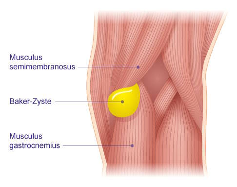 Muskulatur des Kniegelenks von hinten und Lage der Bakerzyste