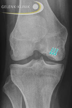 Die Röntgenaufnahme des Knies zeigt den Knochendefekt nach Ablösung des Dissekats. © Gelenk-Klinik Röntgenbild: Knochendefekt nach Ablösung des Dissekats