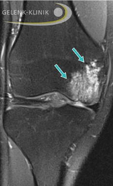 MRT-Darstellung Knie: Die Osteochondrosis dissecans wird von einem ausgeprägten Knochenmarködem begleitet. © Gelenk-Klinik MRT: Knochenmarködem im Knie