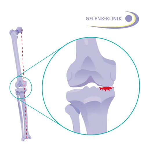 Der flächige Knorpelabrieb auf der Knieinnenseite führt zur O-Beinfehlstellung aufgrund eines Höhenverlustes im Gelenkspalt. Die Patienten leiden unter Schmerzen an der Innenseite des Kniegelenkes. © Gelenk-Klinik einseitiger Knorpelabrieb innen