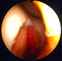 Deutlich sichtbar ist die Knorpelverletzung im Gelenkknorpel. Arthroskopie: Knorpelverletzung im Knie