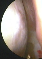 Knorpel ohne Läsion: Die gesunde, glatte Knorpelfläche ist wiederhergestellt. © Dr. Thomas Schneider Arthroskopie: gesunde Knorpelfläche