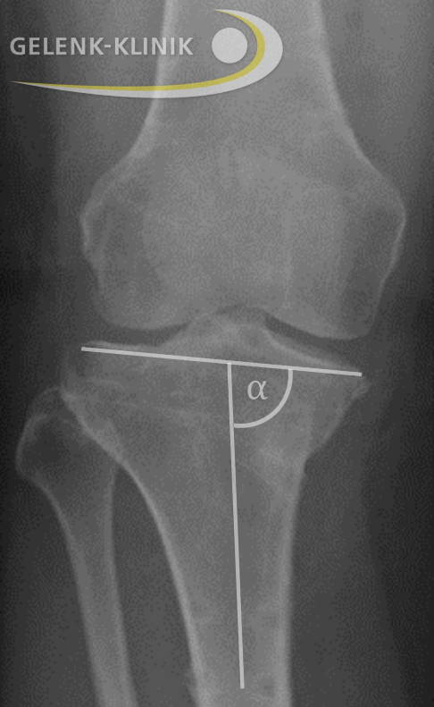 Analyse der Beinachse beim stehenden Patienten vor achskorrigierender Operation: Im vorliegenden Fall liegt eine O-Bein-Fehlstellung im Unterschenkel mit Überbelastung der medialen (inneren) Seite vor. © Gelenk-Klinik Darstellung einer O-Bein-Fehlstellung mit Belastungslinie im Röntgenbild beim stehenden Patienten