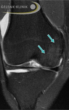 Nach der Behandlung mit einem OATS-Zylinder zeigt sich der Knorpel intakt und die Gelenkfläche wiederhergestellt. Der Knochen ist ebenso abgeheilt, das Ödem kaum noch nachweisbar. © Gelenk-Klinik Kniegelenk nach Knorpel-Knochen-Transplantation