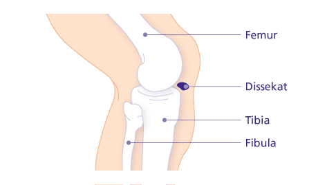 Stadium IV der Osteochondrosis dissecans: Das abgestoßene Dissekat (“Gelenkmaus”) wandert in den Gelenkraum. Als freier Gelenkkörper kann es zu einer Gelenkblockade im Kniegelenk führen. © Gelenk-Klinik Freier Gelenkkörper im Kniegelenk