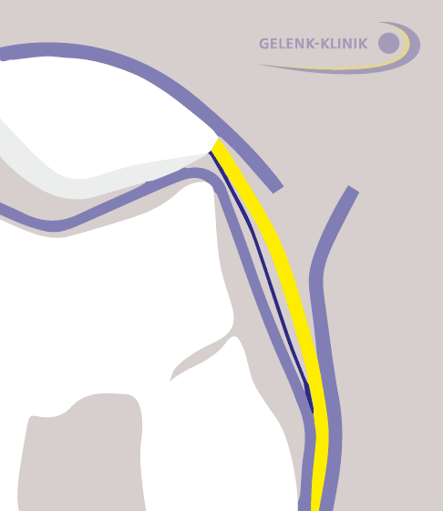 Der Arzt schneidet das äußere Halteband oberflächlich an (blau) und löst es von seinen tiefen Schichten (gelb). © Gelenk-Klinik 1. Schritt der lateralen Retinakulumverlängerung