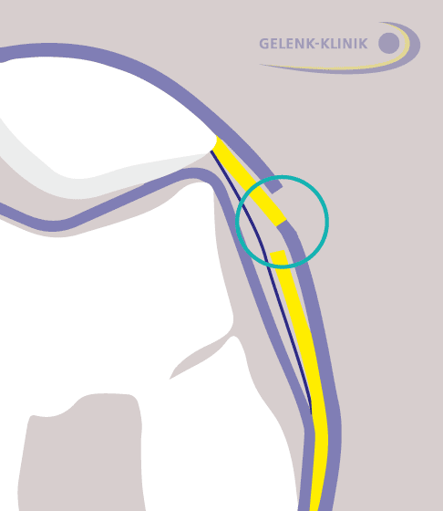 Die neu entstandene Schnittfläche der tiefen Schicht vernäht der Arzt mit der oberen Schicht des Haltebandes. Das Band wird insgesamt länger. © Gelenk-Klinik 3. Schritt der lateralen Retinakulumverlängerung