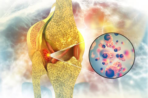 Das Osteosarkom ist ein bösartiger Tumor des Knochengewebes. © Crystal light, Adobe Stock Osteosarkom