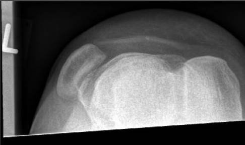 Röntgenbild: Luxation der Patella nach links. © Gelenk-Klinik Patellaluxation