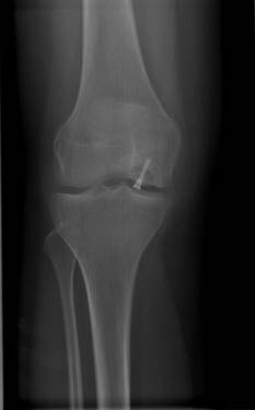 Die Röntgenaufnahme des Knies zeigt die Refixation eines abgelösten Knorpel-Knochen-Fragments. Dies kann mittels Titanschrauben (wie dargestellt) oder resorbierbarer Schrauben erfolgen. © Gelenk-Klinik Röntgen: Refixation eines abgelösten Knorpel-Knochen-Fragments