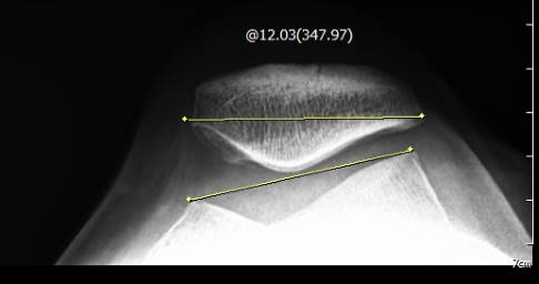Vor OP: Kippstellung der Patella von 12° durch starken Zug der seitlichen Haltebänder. © Gelenk-Klinik Kippstellung der Patella