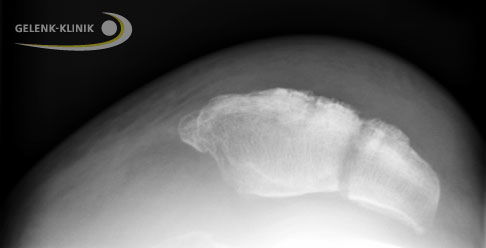 Röntgenaufnahme einer gebrochenen Kniescheibe. Diese spezielle Aufnahmetechnik nennt man Defilée-Aufnahme. Dabei liegt der Patient mit angestellten Beinen auf dem Rücken. © Gelenk-Klinik Patellafraktur, Kniescheibenbruch
