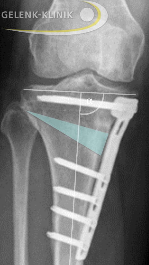 Analyse der Beinachse beim stehenden Patienten nach achskorrigierender Operation: Nach der Umstellungsosteotomie ist die Überlastung auf der medialen (inneren) Seite korrigiert. © Gelenk-Klinik Röntgenbild eines stehenden Patienten nach Umstellungsosteotomie mit Belastungslinie