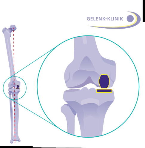 Die Implantation eines Teilgelenkersatzes (dunkelblau) verschafft dem Patienten Schmerzfreiheit. Die Teilprothese bringt Ober- und Unterschenkel auf der betroffenen Seite wieder auf eine größere Distanz. Dadurch wird nicht nur die ursprüngliche Bandspannung wiederhergestellt, sondern auch die Beinachse korrigiert (gestrichelte Linie). © Gelenk-Klinik Teilgelenkersatz im Knie