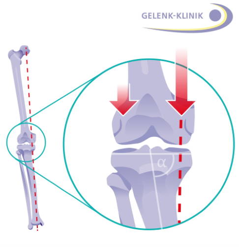 Besteht eine Beinfehlstellung, verläuft die mechanische Beinachse nicht durch die Mitte der beteiligten Knochen, sondern seitlich versetzt (gestrichelte Linie). Dies hat eine ungleiche Gewichtsbelastung (rote Pfeile) und damit eine Abnutzung des Gelenkknorpels zur Folge. © Gelenk-Klinik Schematische Darstellung der fehlgestellten mechanischen Beinachse