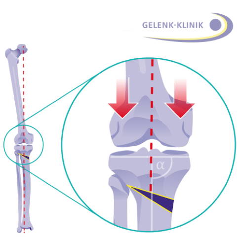 Eine Umstellungsosteotomie korrigiert die Beinfehlstellung und verteilt die von oben wirkende Last gleichmäßig auf die gesamte Knorpelfläche. © Gelenk-Klinik Kniegelenk nach Korrektur durch eine Umstellungsosteotomie