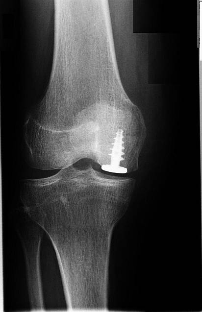 Das aufgeraute Gewinde des Hemicap-Schaftes erlaubt ein stabiles und zementfreies Einheilen des umgebenden Knochens. Diese Oberflächenersatzprothese kann kleinere Knochen- und Knorpelschäden direkt überdecken. Die minimalinvasive OP-Technik sorgt für eine im Vergleich zur Vollprothese schnelle, schmerzarme und komplikationsfreie Heilung. Der deutlich sichtbare Gelenkspalt im Röntgenbild zeigt, dass die gelenkschützende Knorpelschicht in diesem Kniegelenk noch völlig intakt ist. © Prof. Dr. med. Ostermeier Kniegelenk mit Osteonekrose, das durch ein Hemicap-System versorgt wurde