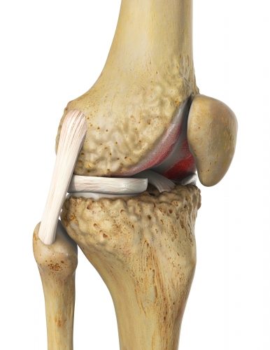 Kniegelenk mit Retropatellararthrose: Sichtbar ist die Kniescheibe mit deutlichem Knorpelabrieb im Femoropatellargelenk. Charakteristisch für die fortgeschrittene Arthrose ist die Bildung von Knochenanbauten (Osteophyten) im Kniegelenk. © Viewmedica Retropatellare Arthrose oder patellofemorale Arthrose