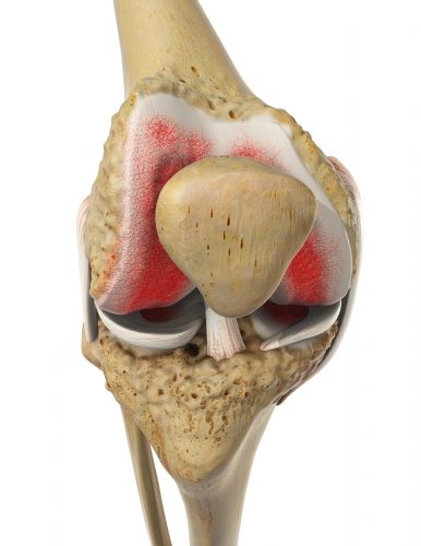 Bei einer Arthrose kommt es zur Abnutzung der schützenden Knorpelschicht im Gelenk. © Viewmedica Arthrose des Kniegelenks