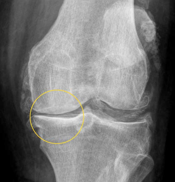 Röntgenbild von hinten unter Belastung: Darstellung des rechten Kniegelenks mit medialer Gonarthrose. Deutlich sichtbar ist der verschmälerte Gelenkspalt. © Gelenk-Klinik Röntgenbild der Arthrose im Kniegelenk