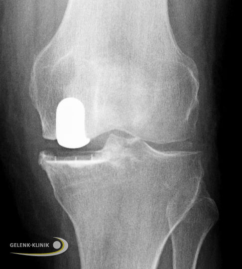 Allergieimplantat bei einer Patientin mit bekannter Nickelallergie. Die Schlittenprothese besitzt eine Titan-Nitrid-beschichtete Oberfläche. ©Gelenk-Klinik Allergieimplantat im Kniegelenk