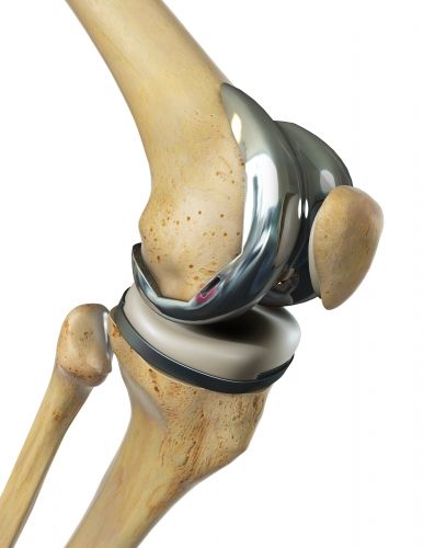 Die Knieendoprothese ersetzt das natürliche Kniegelenk bei schwerer Arthrose. Dabei bedeckt ein Teil der Prothese das Ende des Oberschenkelknochens (Femur). Der andere Teil bedeckt das Schienbeinplateau. Die Polyethylen-Metall-Gleitpaarung stellt die Beweglichkeit im Kniegelenk wieder her. So kann der Patient auch nach einer schweren Kniearthrose wieder beschwerdefrei gehen. © Viewmedica Knieprothese
