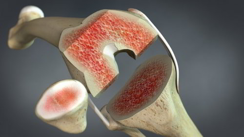Implantation der Knieprothese: Zunächst bereitet der Arzt den Knochen mit Sägeschnitten vor. Dann werden in das Kniegelenk Platzhalter eingesetzt, um die Beweglichkeit zu prüfen. Anhand der Platzhalter entscheidet der Orthopäde über die geeignete Prothesengröße. Dann kann das Implantat im Knochen von Ober- und Unterschenkel befestigt werden. © Viewmedica Implantation der Knieprothese