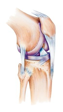 Anatomisches Bild des gesunden Knies mit Kniescheibe (Patella), Seitenbändern, Kreuzbändern und Meniskus. Die Arthrose des patellofemoralen Gelenks betrifft die femoropatellare Gleitrinne (Trochlea), also den Bereich zwischen den beiden großen Oberschenkelrollen (Femurkondylen). Kniescheibe und Trochlea sind bei jedem Menschen individuell geformt. Bei manchen Patienten führt die Form zu einer Instabilität des Femoropatellargelenks. Die Kniescheibe liegt dann zu hoch (Patella alta) oder sie springt leicht aus dem Gelenk heraus. All diese Faktoren können zu einer retropatellaren Arthrose führen. © Istockphoto.com/MedicalArtInc Anatomisches Bild des Kniegelenks