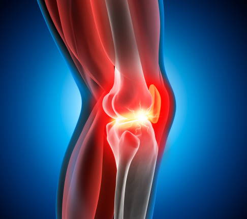 Eine Osteochondrosis dissecans im Knie führt zu Knieschmerzen und Schwellungen im Gelenk. © peterschreiber.media schmerzendes Kniegelenk aufgrund von Osteochondrosis dissecans