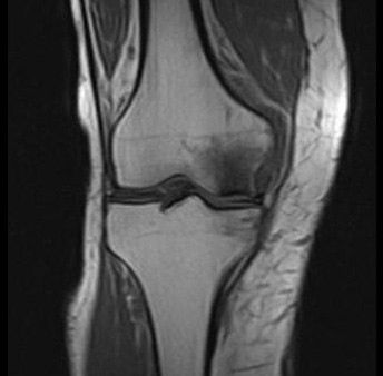 Das MRT zeigt eine Osteonekrose im Kniegelenk an der inneren Oberschenkelrolle. © Gelenk-Klinik MRT: Osteonekrose bei Morbus Ahlbäck