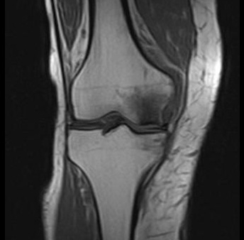 MRT-Aufnahme von Morbus Ahlbaeck (Knochennekrose im Kniegelenk)