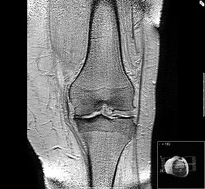 MRT-Bild einer Kniearthrose: Deutlich zu erkennen ist innen der schmalere Gelenkspalt auf der linken Seite. Meist reichen Röntgenbilder aus, um eine Gonarthrose sicher festzustellen. Eine MRT kann im Einzelfall hilfreich sein, weil sie Schäden an Bändern und Menisken besser darstellt. © Gelenk-Klinik MRT-Bild einer Kniearthrose mit deutlich verschmälertem Gelenkspalt